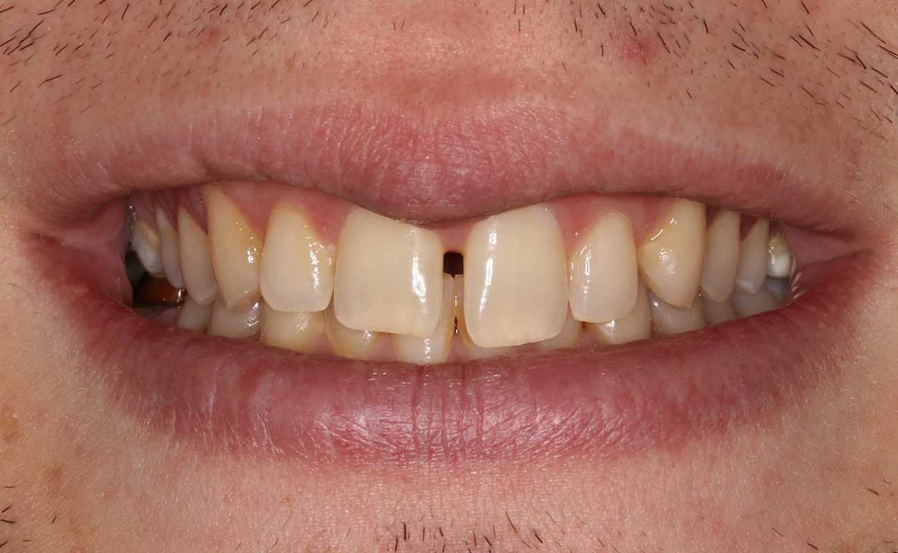 Treatment Before Image Reading | Aspire Clinic