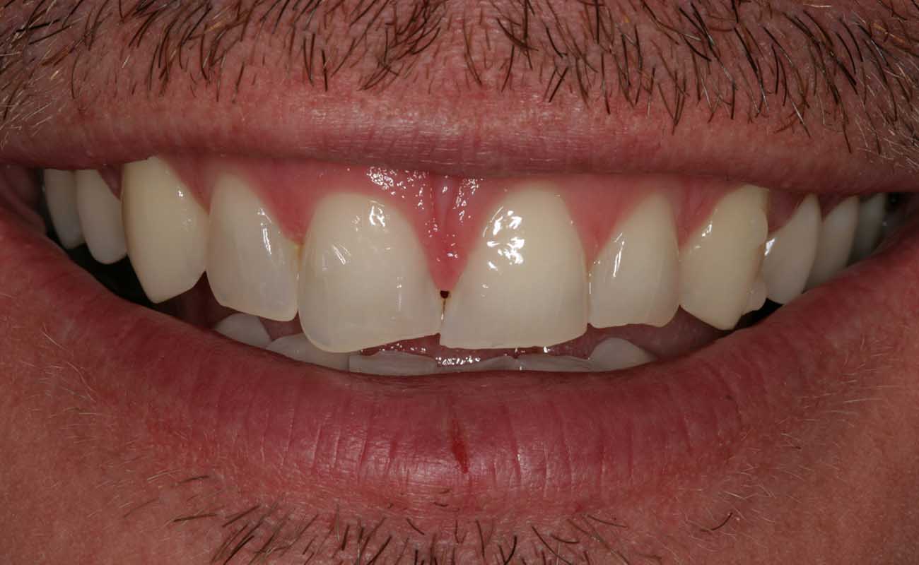 Treatment Before Image Reading | Aspire Clinic