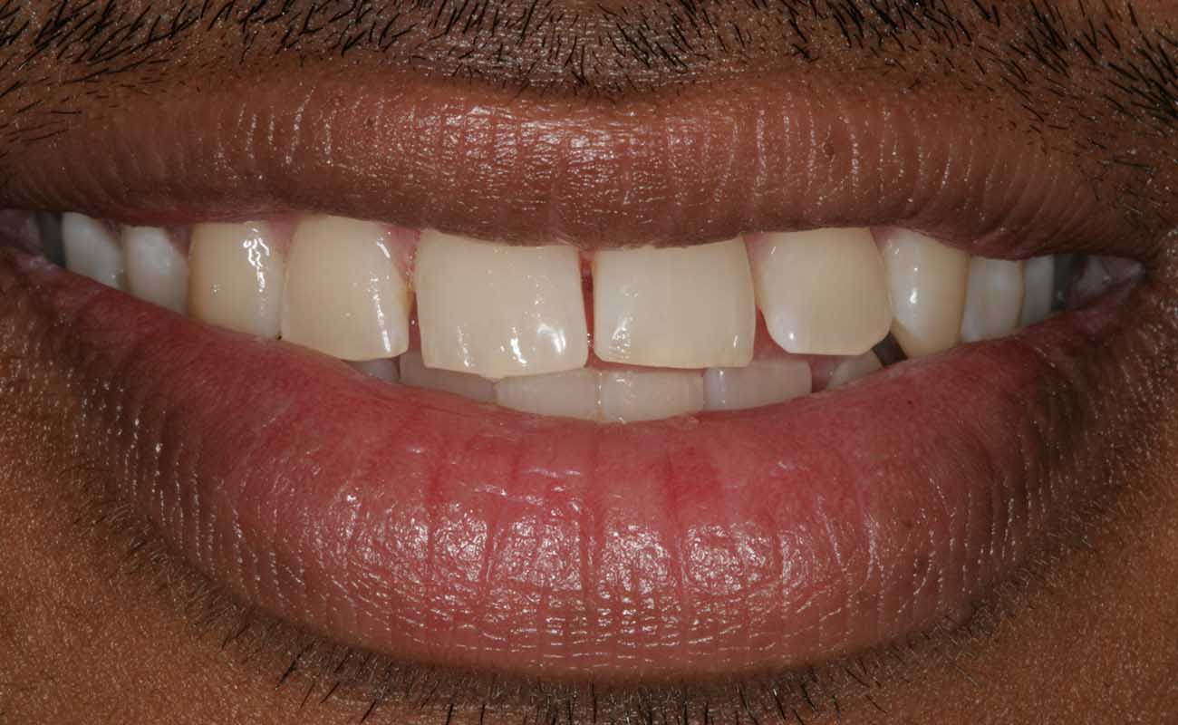 Treatment Before Image Reading | Aspire Clinic