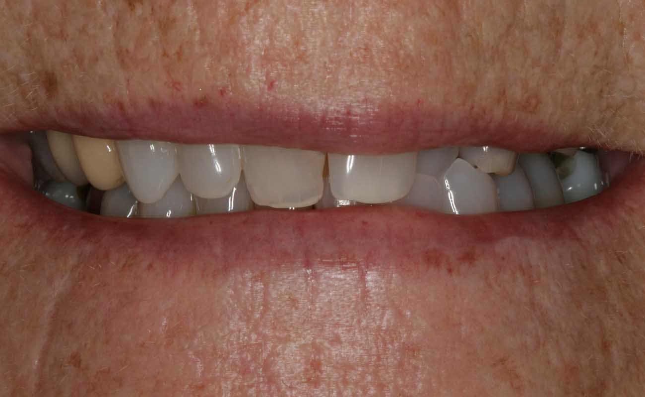 Treatment Before Image Reading | Aspire Clinic